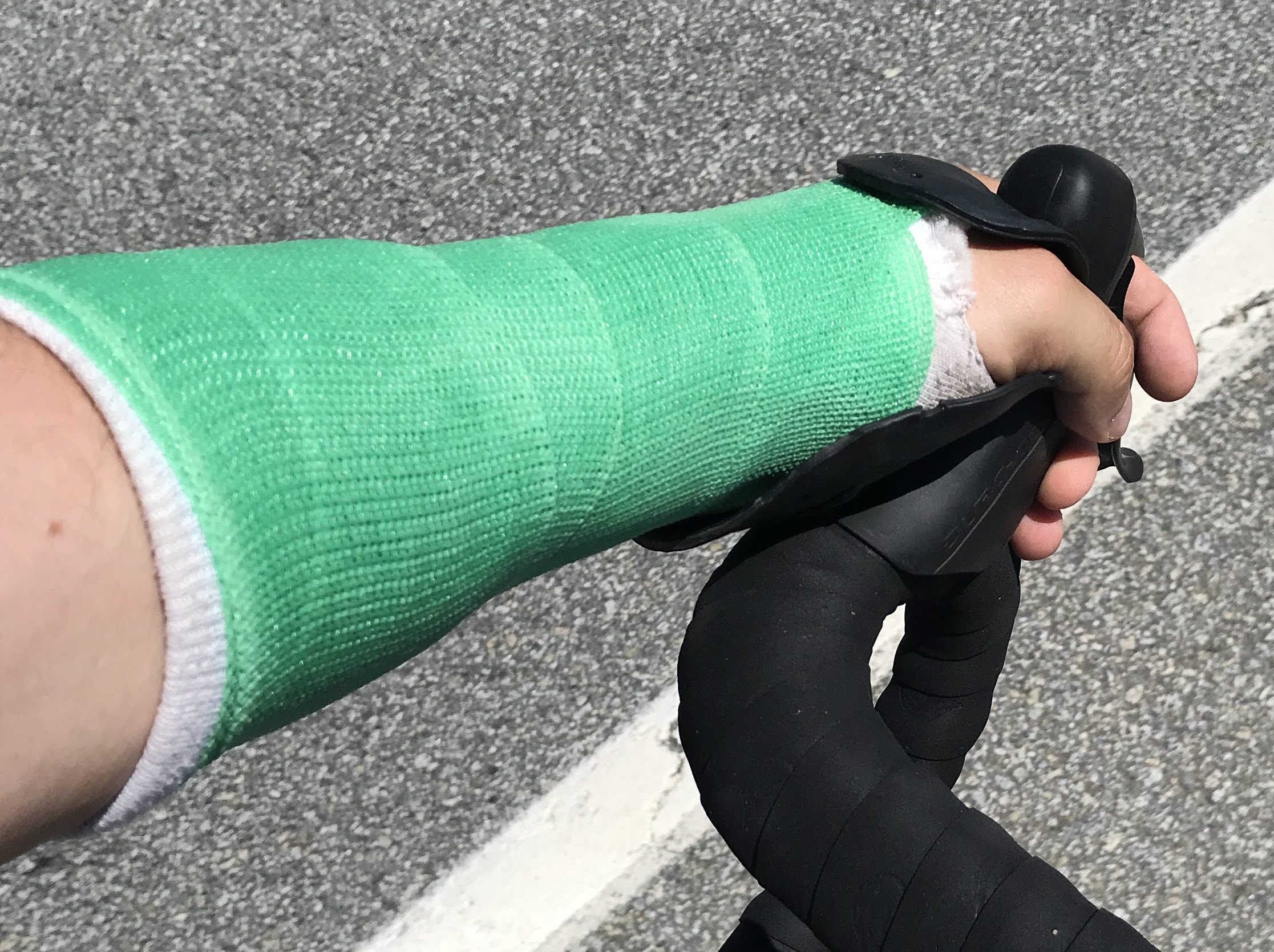cycling splint in action